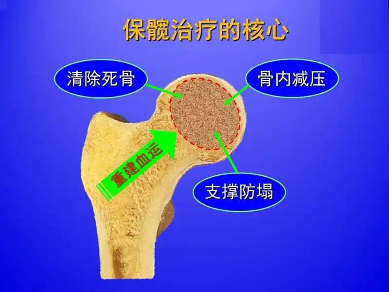 股骨头坏死别怕这样做能少走弯路,股骨头坏死保守治疗能逆转吗