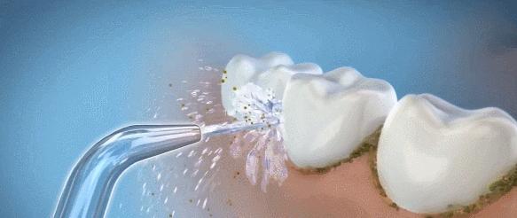 冲牙器和电动牙刷哪个效果好视频,电动牙刷冲牙器对比