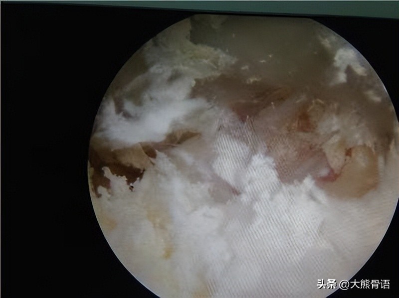 手指痛风的初期症状和治疗,脚踝痛风的症状和治疗方法