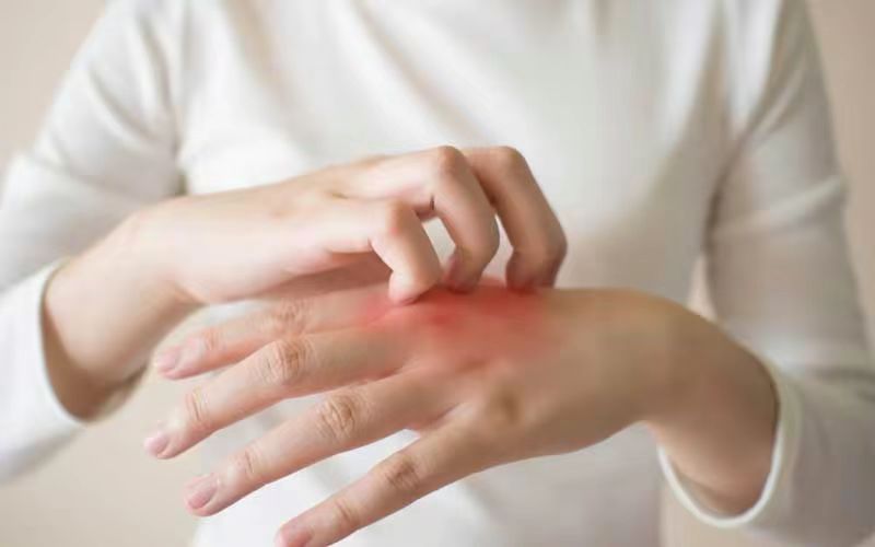 荨麻疹怎么治疗遇冷风就起疙瘩,风疙瘩和丘疹性荨麻疹