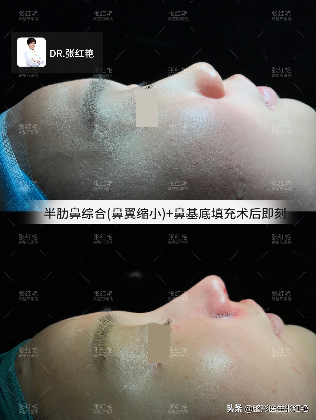 鼻子整形变美视频,鼻子整容成功明星