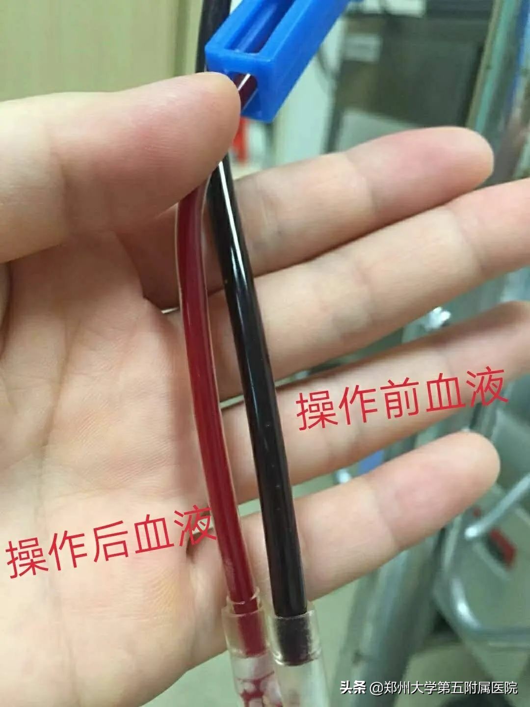 三氧疗法成功治疗脑溢血偏瘫案例,超氧自体血疗法对脑梗有益处吗