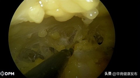 微创腹腔镜是什么,腔镜手术皮下隧道恢复时间
