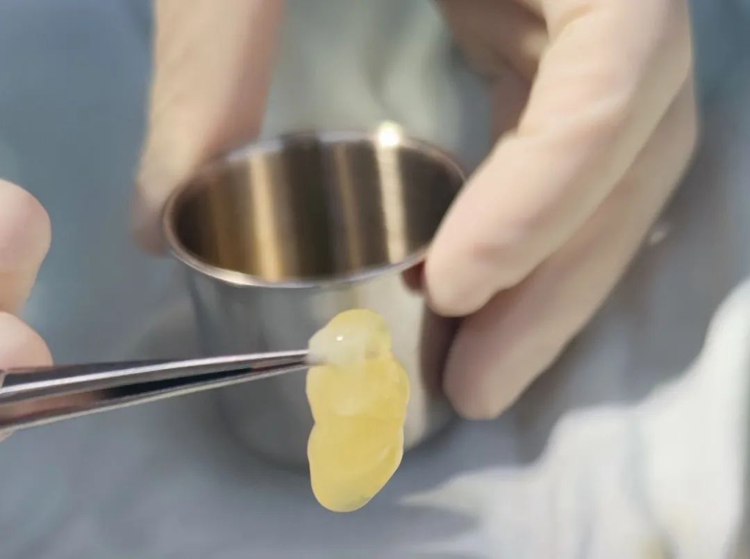 伤口化脓十天还没好,伤口破了好几天一直流脓