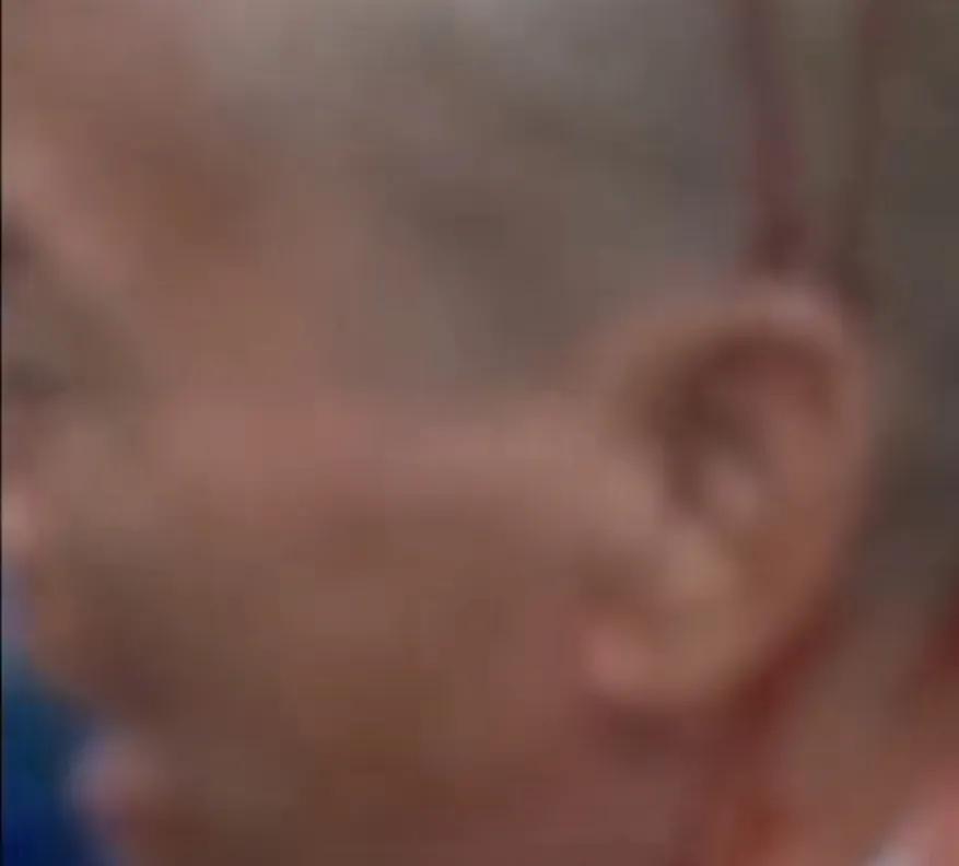 头部被硬物砸到起包了出了一点血,老人开颅手术后脑梗