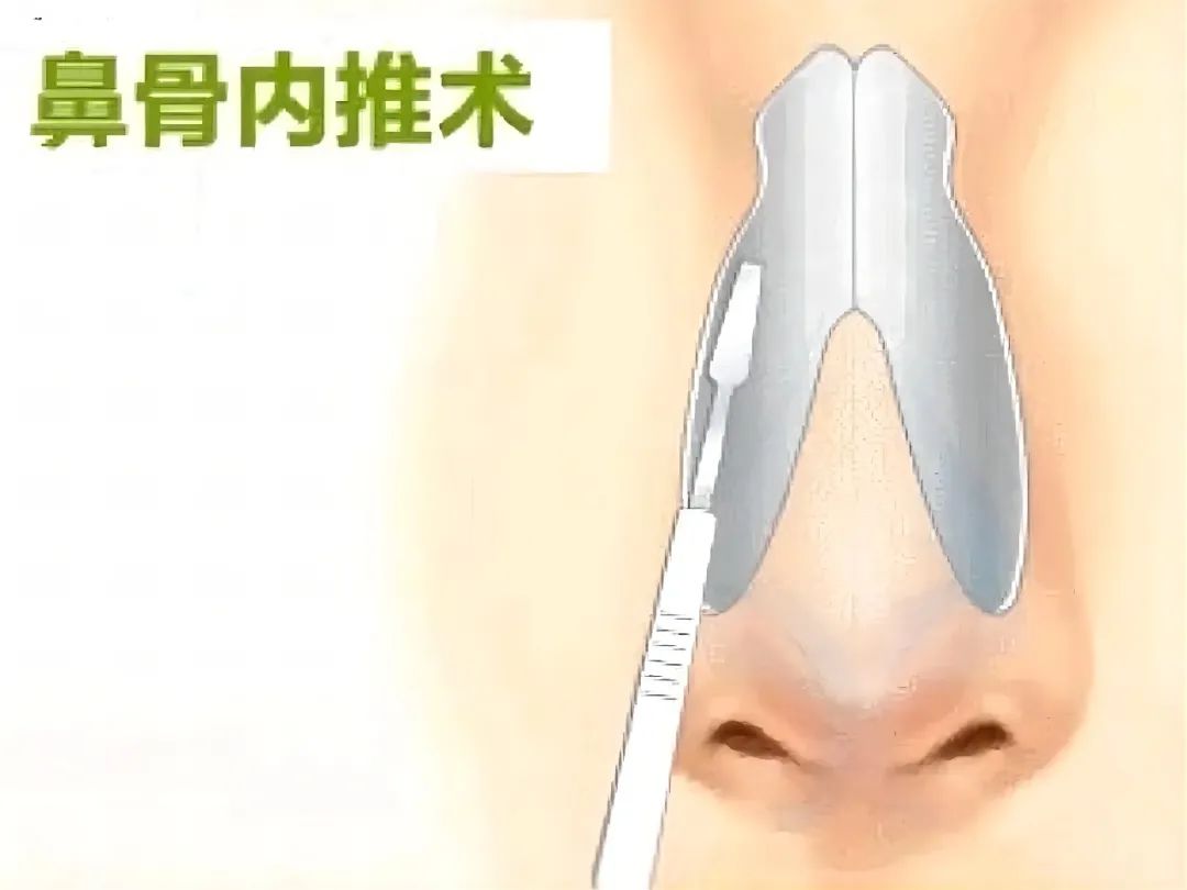 脸比较扁塌适合做什么鼻型,鼻型很难看该怎么改善