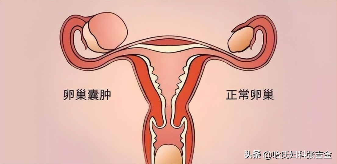卵巢囊肿克星,卵巢囊肿怎么化瘀