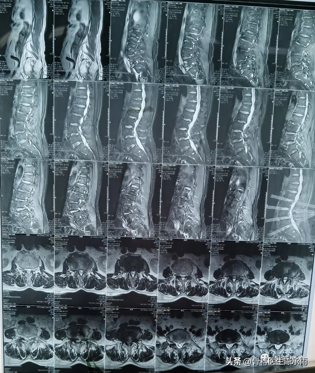 腰椎滑脱椎管狭窄手术后遗症,腰椎间盘突出椎管狭窄的手术