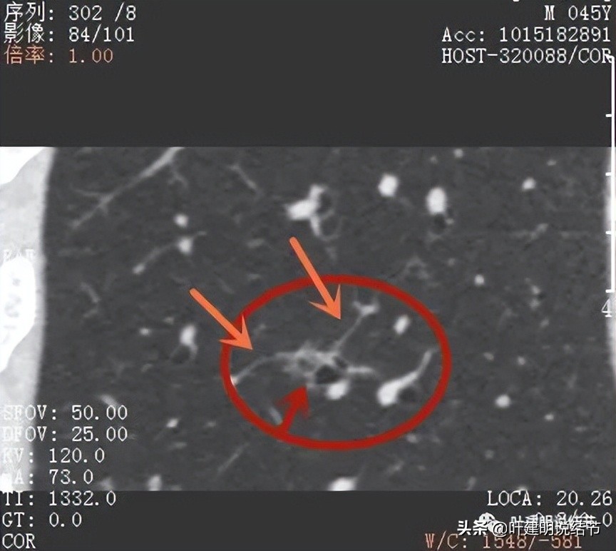 误诊肺纤维化,肺蜂窝状是癌吗