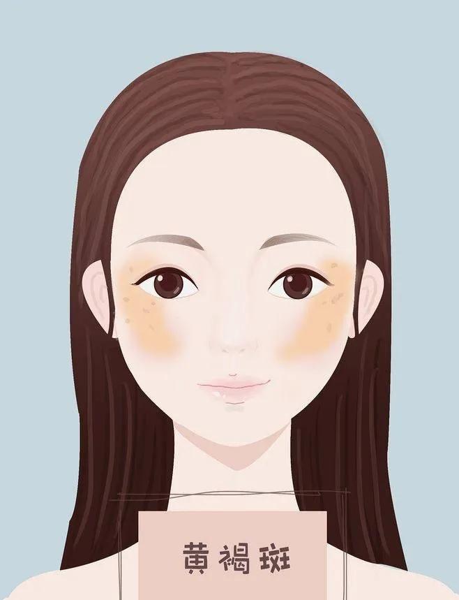 30岁脸上长斑怎么办需要注意什么,产后脸上有斑怎么办需要注意什么