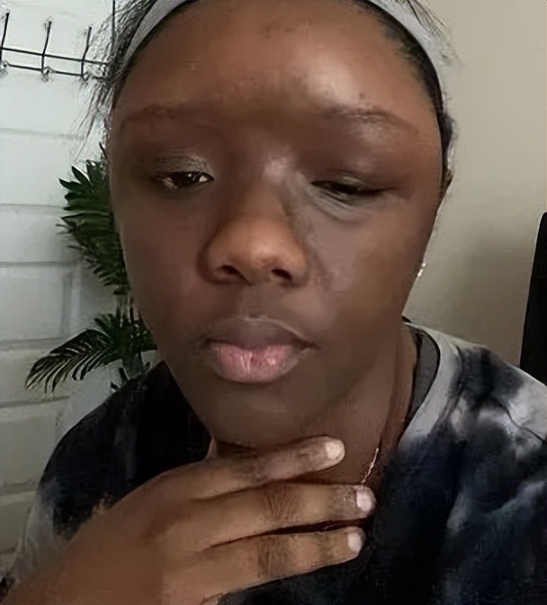 美国妹子染头发过敏全脸肿成emoji，不光失明还险些窒息