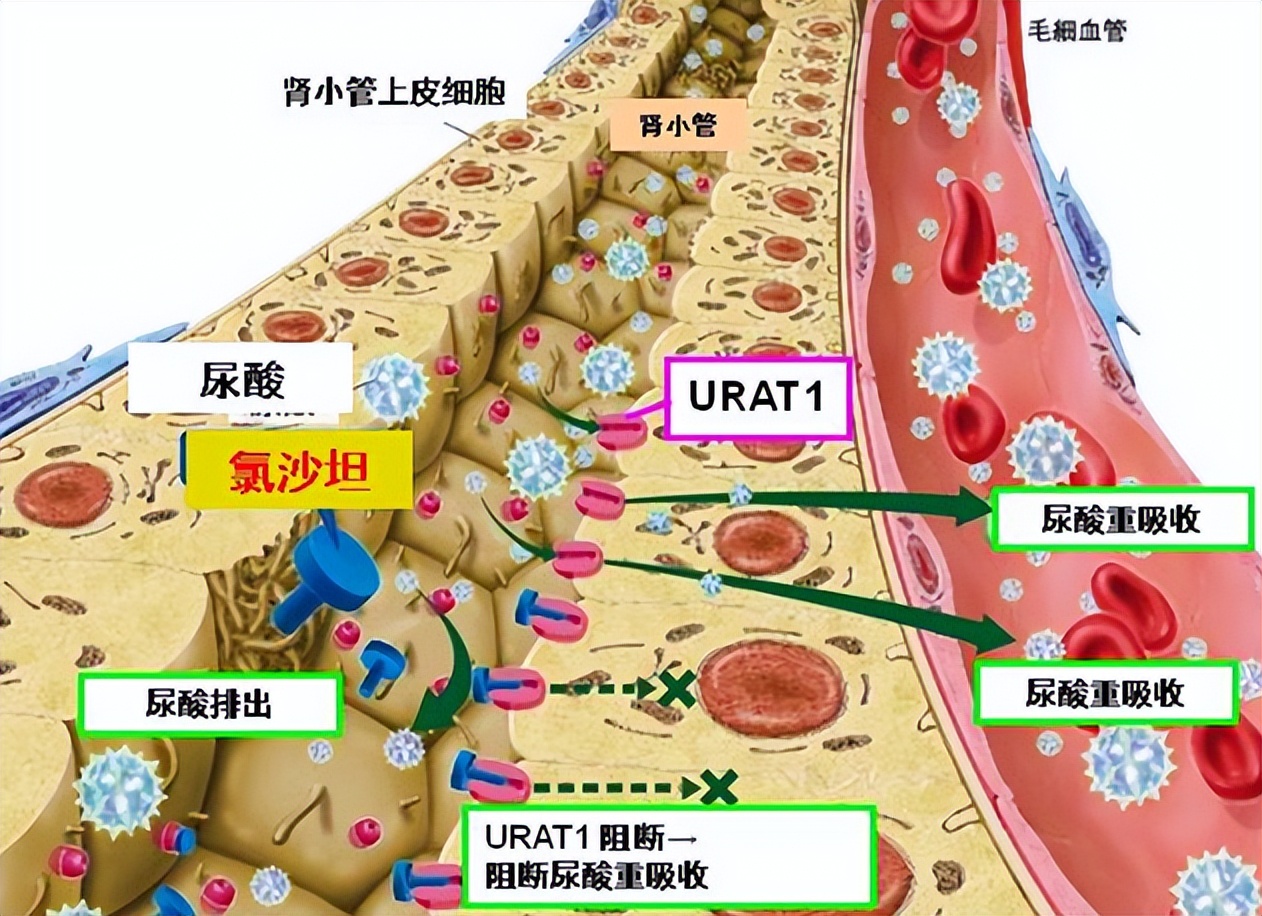 高血压痛风患者,高血压患者痛风急性发作时怎么办