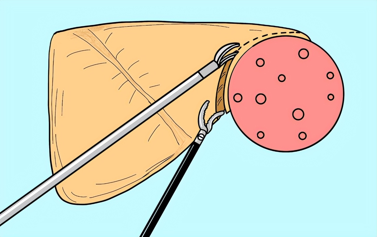 医生说囊肿是良性的但是需要手术,医生处理囊肿的视频