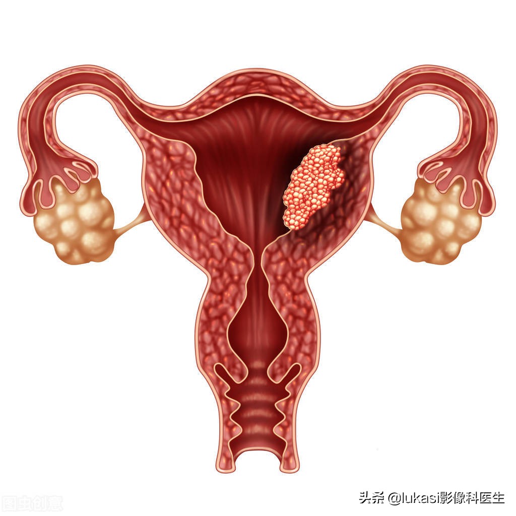 绝经后子宫内膜癌征兆,绝经后子宫癌症早期信号