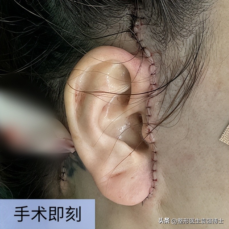 拉皮术后1-7天照片,科普一波大拉皮手术恢复期多少天