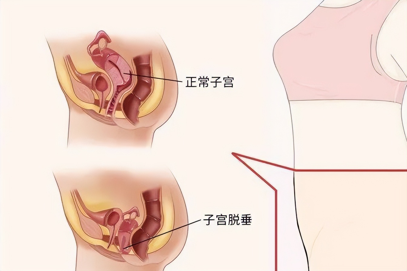 女性阴衰是什么原因造成的,阴挺怎么治疗最快