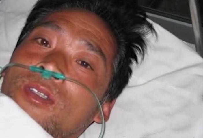 日本工人遭核辐射，被当白鼠强行续命83天，临终前烂成“烤全羊”