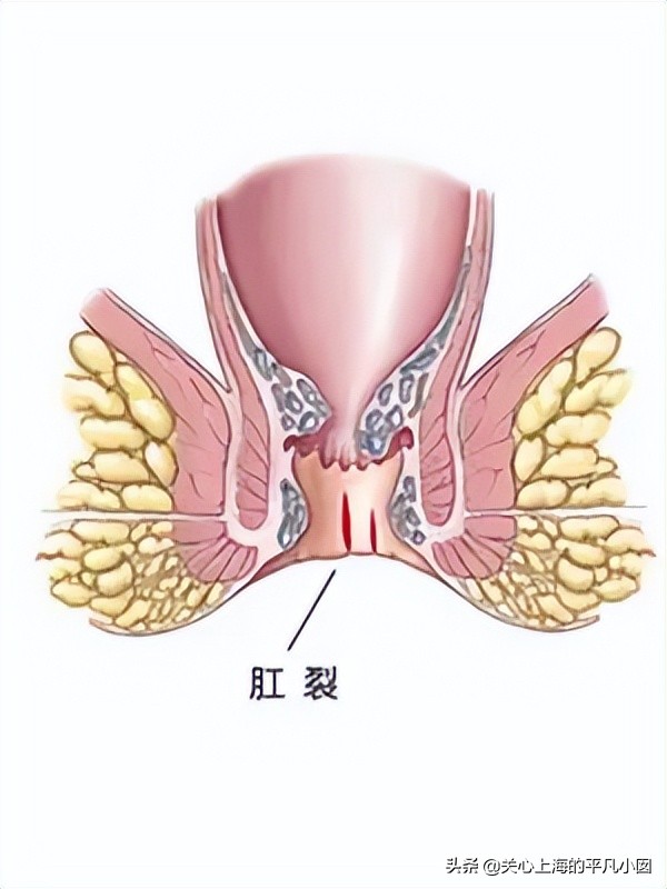 痔疮肛门痛用什么药,肛门瘙痒痛是痔疮吗