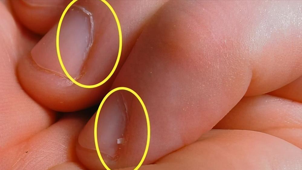 甲沟炎如何快速拔出脚趾甲,脚趾甲老往肉里钻一碰还疼