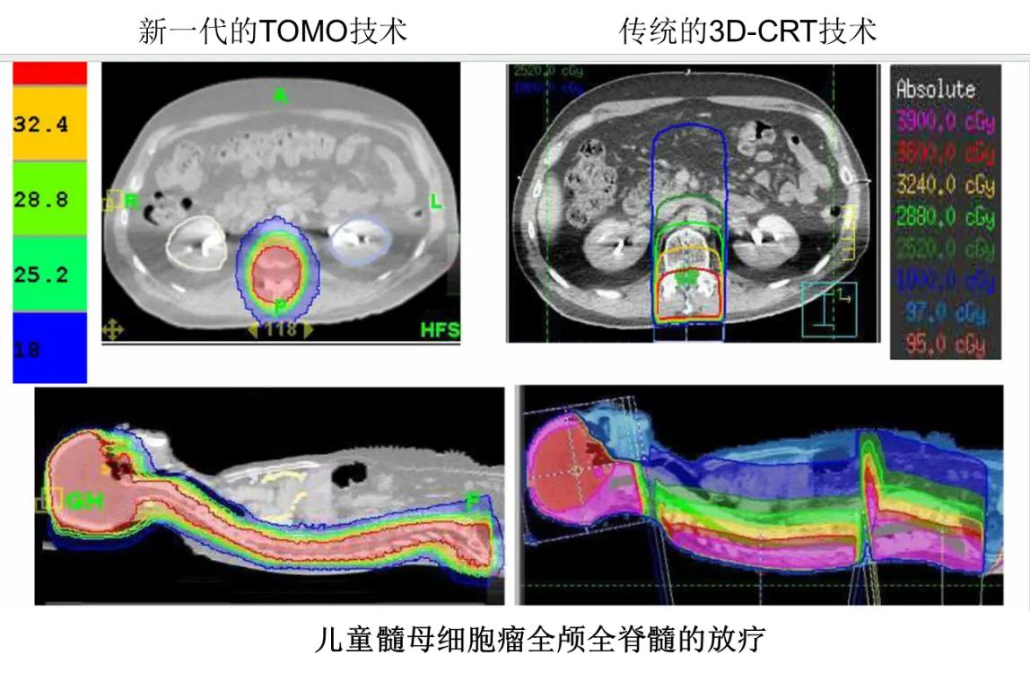 tomo全脑全脊髓放疗副反应,tomo治疗垂体瘤