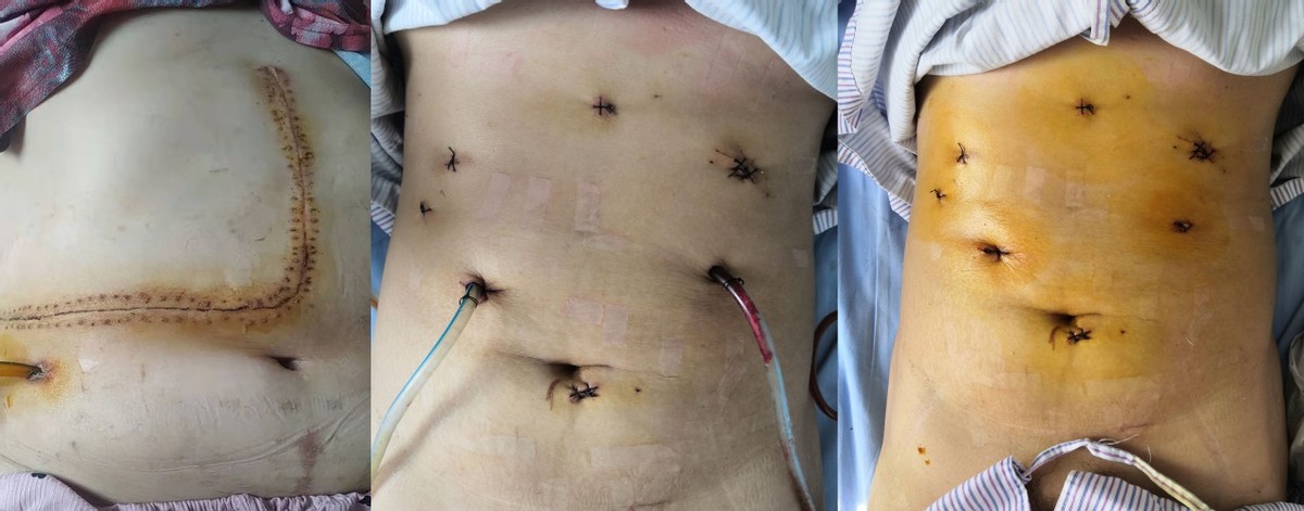 哈医大一院肝脏外科微创切除累及下腔静脉15厘米巨大肝血管瘤