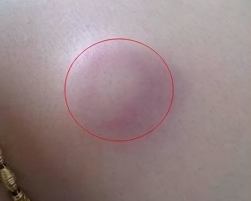 脖子腋下长小肉粒可以用手揪掉吗,脖子旁边出现小肉粒能直接揪掉吗