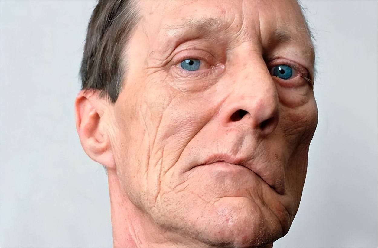 治疗面瘫的中药喝了多久有效果呢,治疗面瘫三样特效药