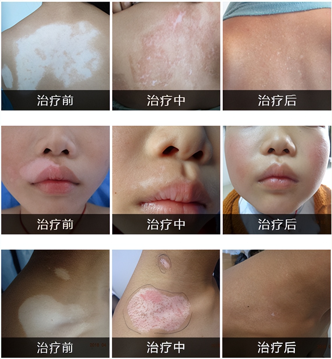 长期照黑光副作用,长期照黄光皮肤会怎么样