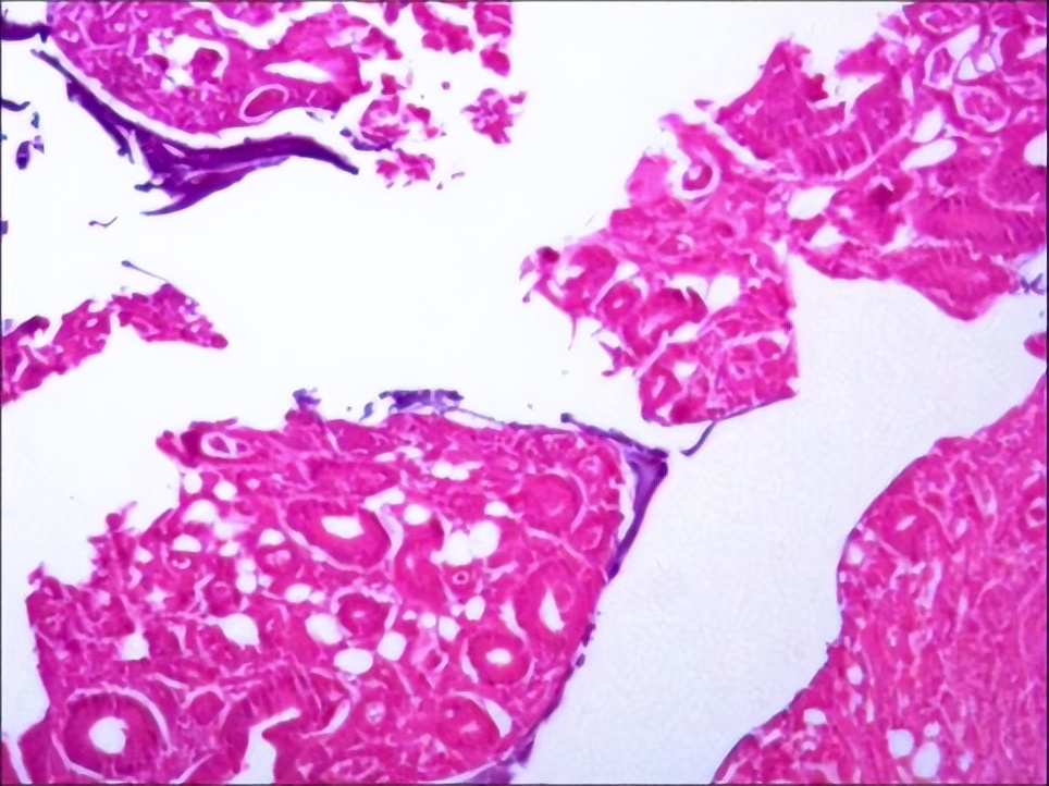 多原发癌症转移,多原发直肠癌
