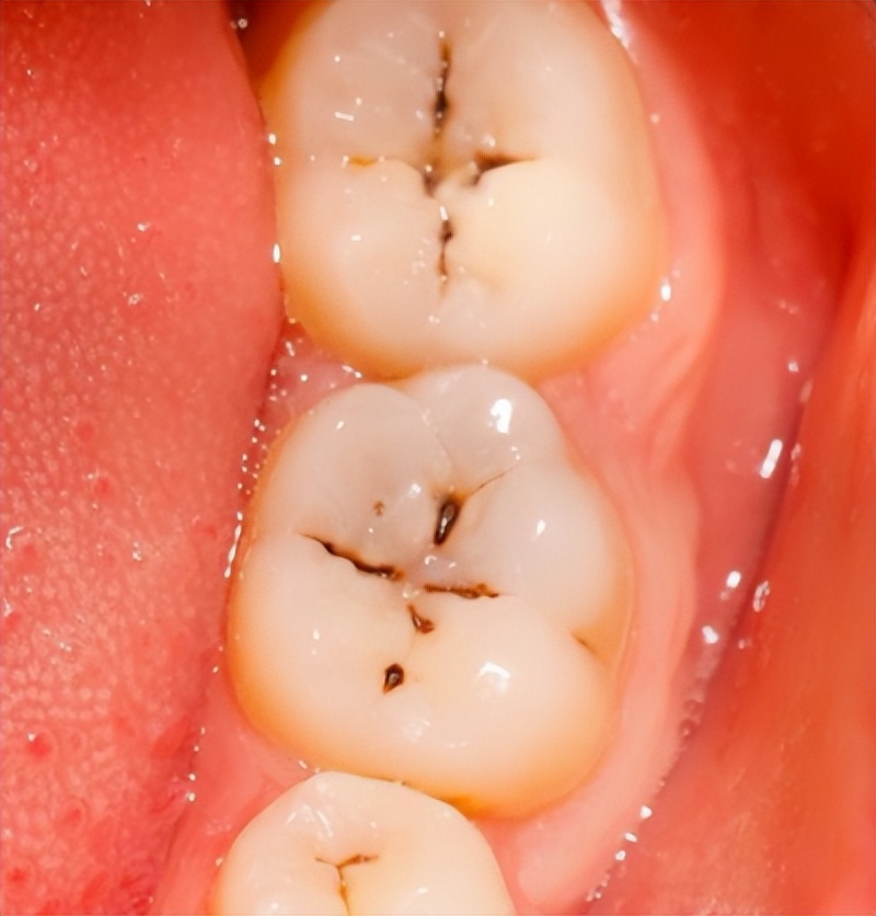 牙齿掉了一小块怎么办,拔牙掉了一块肉怎么办