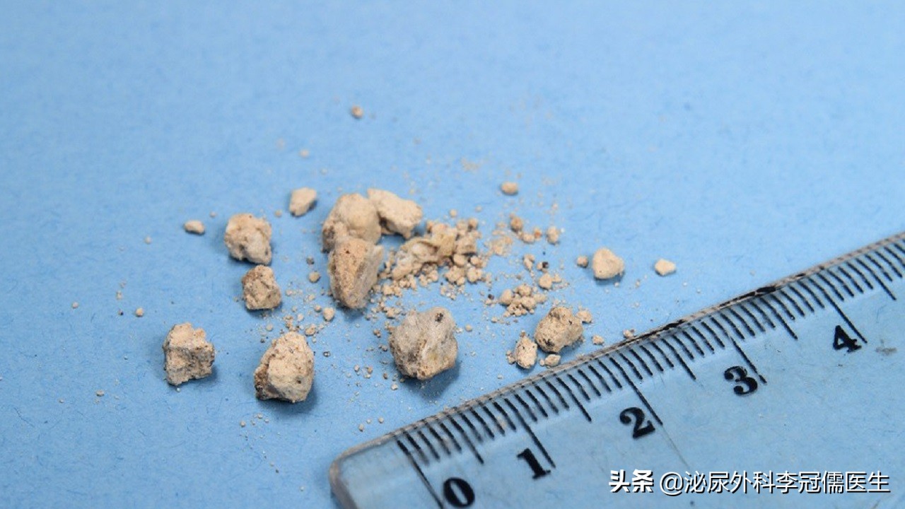 怎样能彻底根治尿结石,尿路结石怎么快速缓解尿意