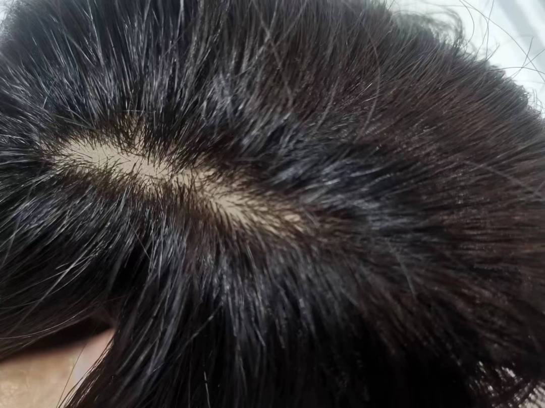 白头发除了可以染色还可以试试假发，亲身经历总结8个热点问题