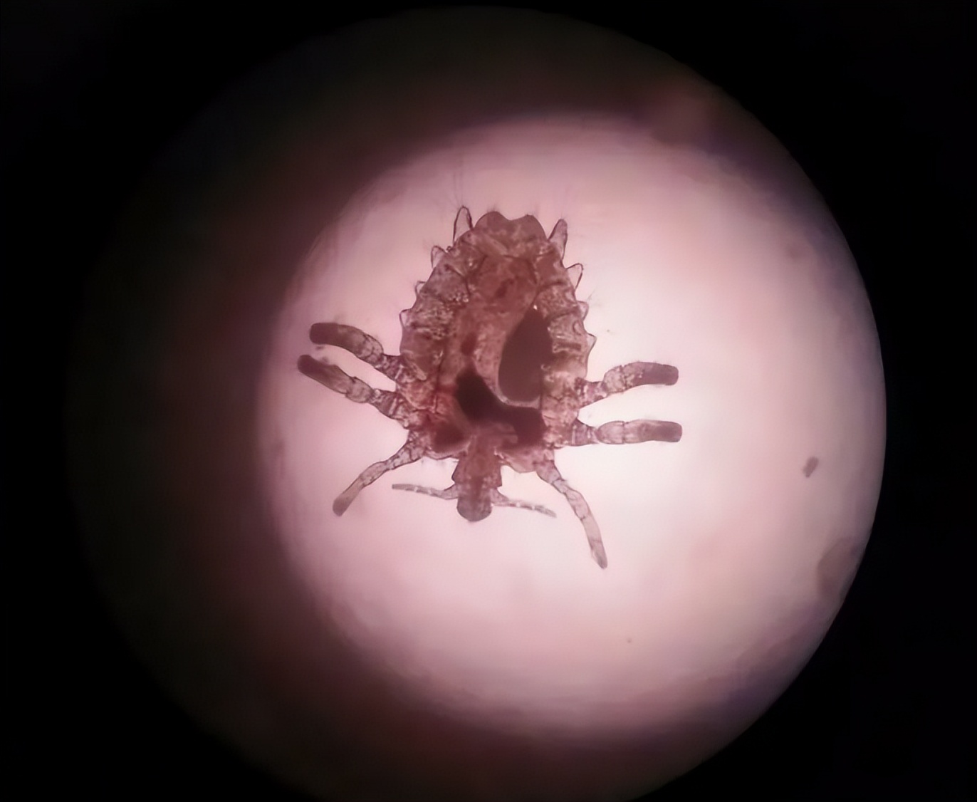 男子腹部痒,男性大量阴虱和虫卵