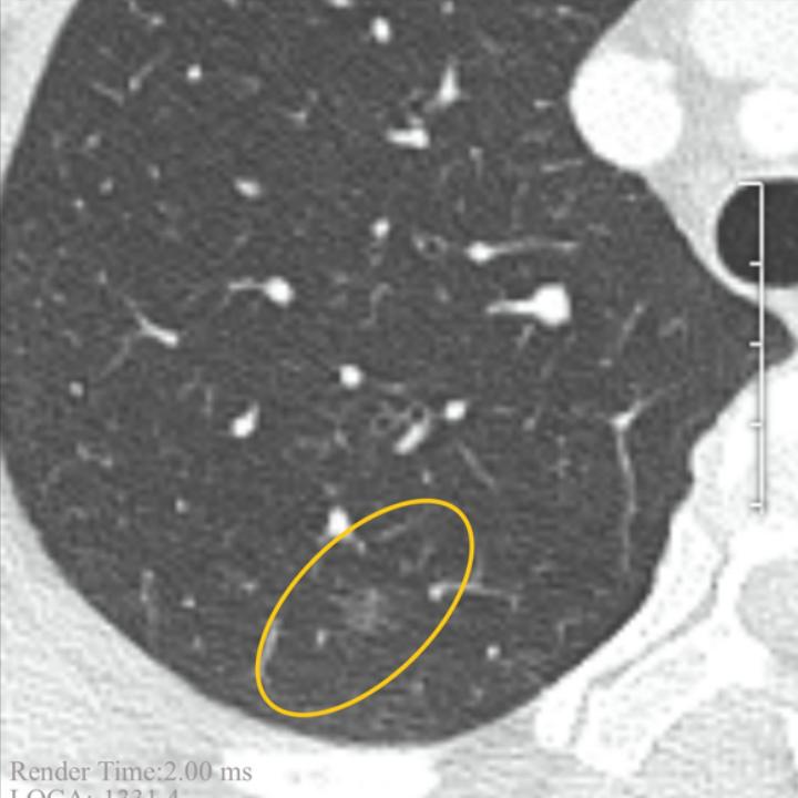 宫颈癌术后肺磨玻璃结节,宫颈癌或者癌前病变