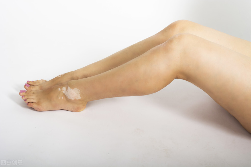 脚趾有白癜风好治疗吗,脚部患白癜风该怎么办呢