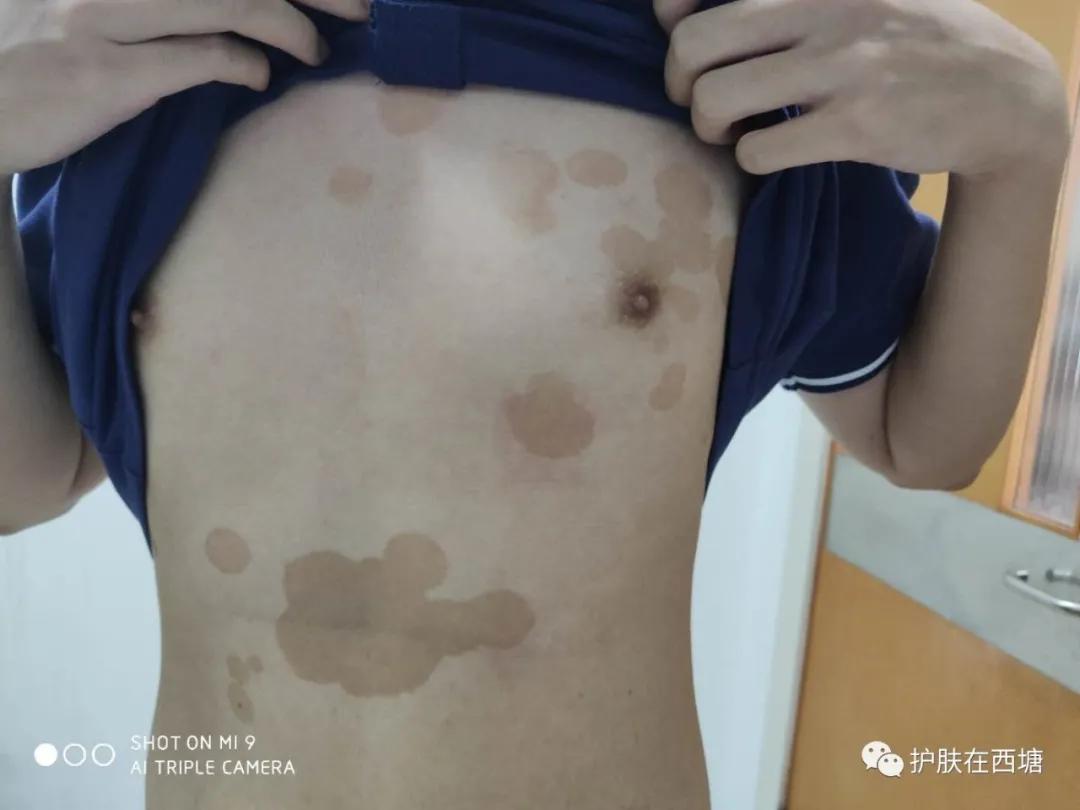 汗斑跟花斑癣,汗斑和花斑糠疹区别