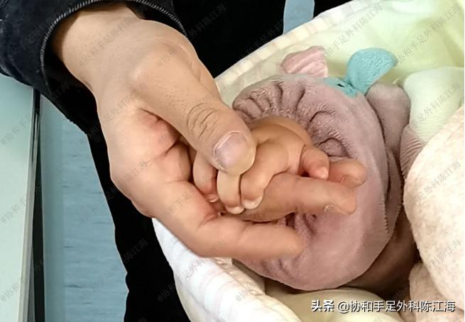 宝宝拇指畸形能矫正吗,孩子拇指畸形是什么原因