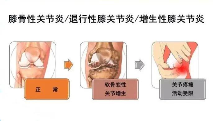 一招解决膝盖寒气,治膝关节冷的方法