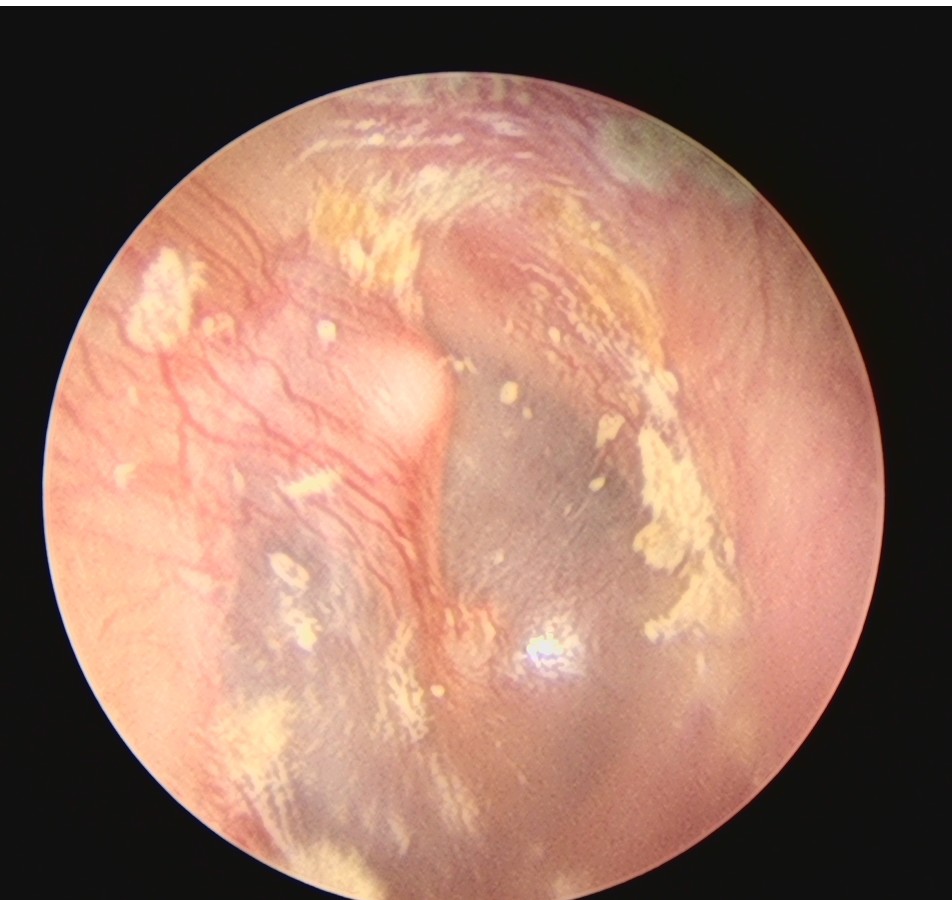 面肌痉挛耳后微创治疗,面肌痉挛外科微创诊治副作用