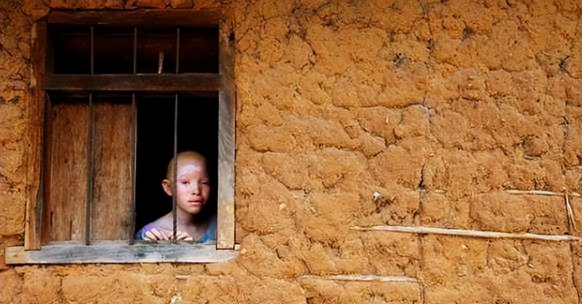 非洲最特殊的人群：血液堪比黄金，遗骸卖上百万，却无法健康成长