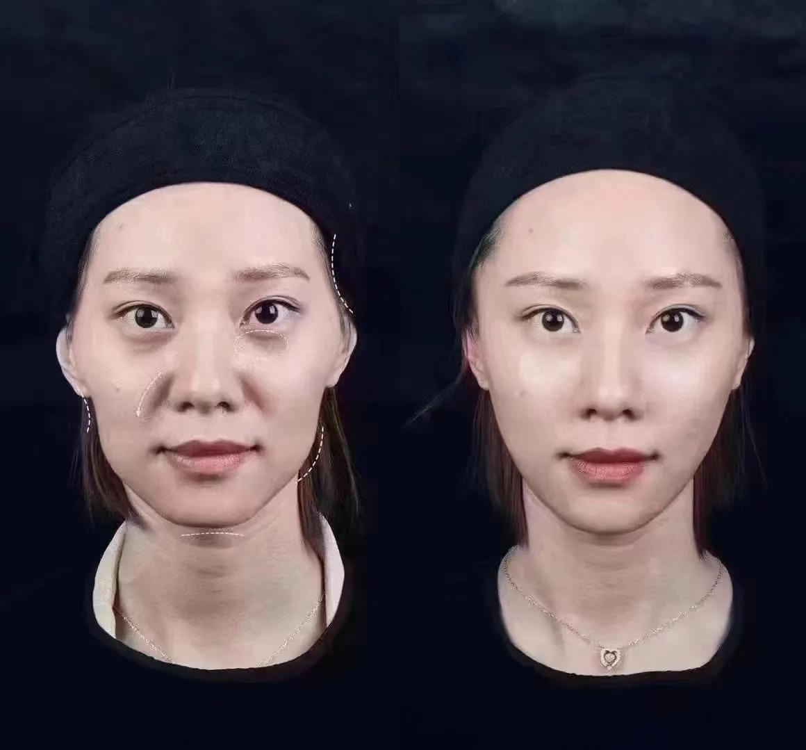 拉皮手术全过程要几个小时,拉皮手术的十大危害