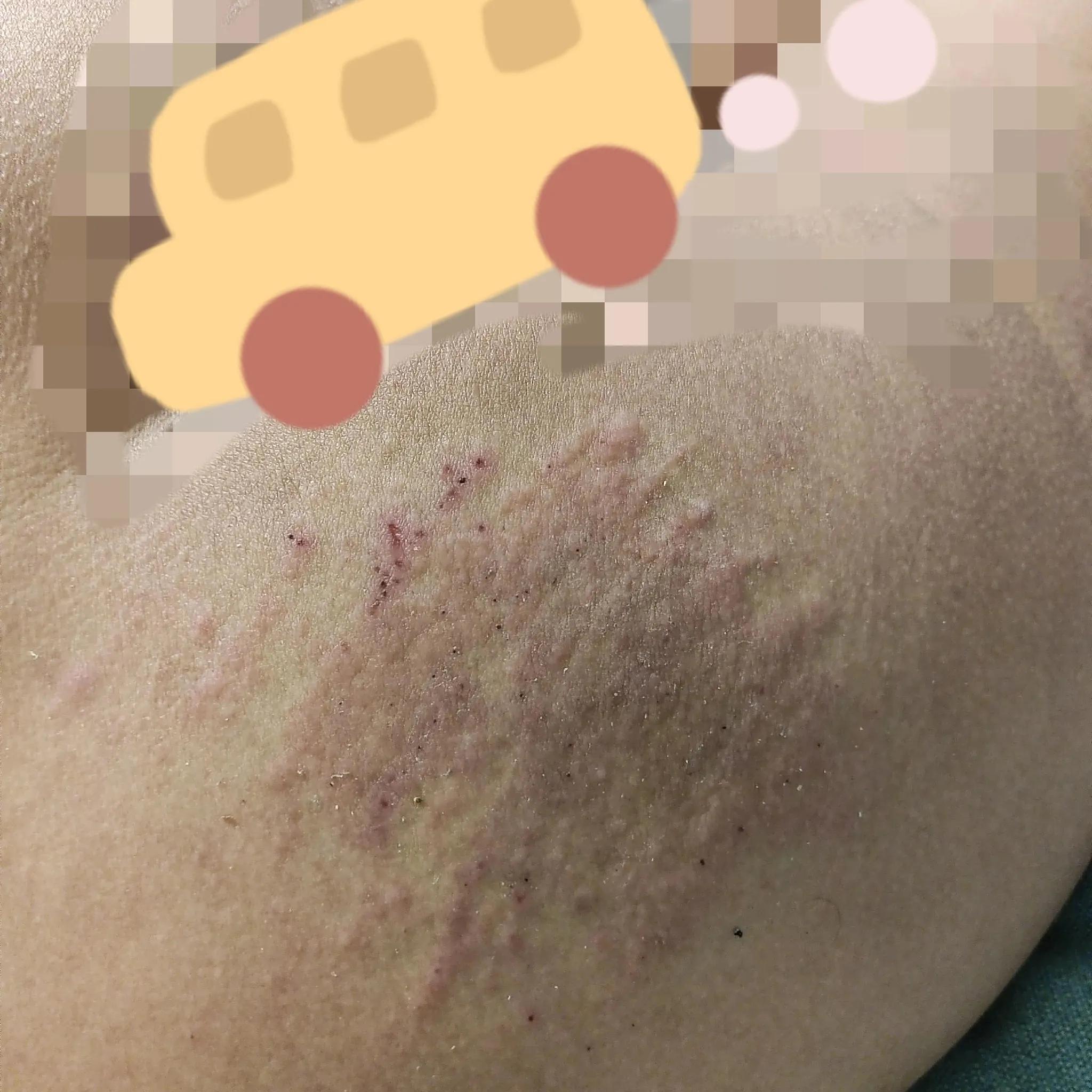 风疹不治疗可以自愈吗,风疹病毒治疗多少钱