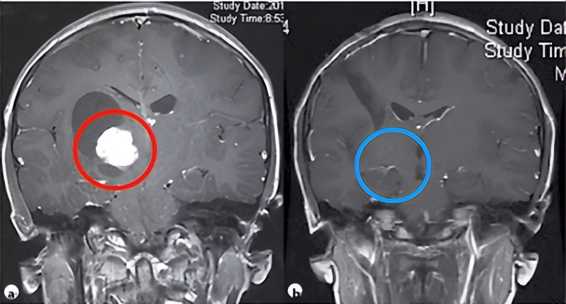 小儿脑瘤并非都治愈无望！家长关心的热点问题汇总答疑