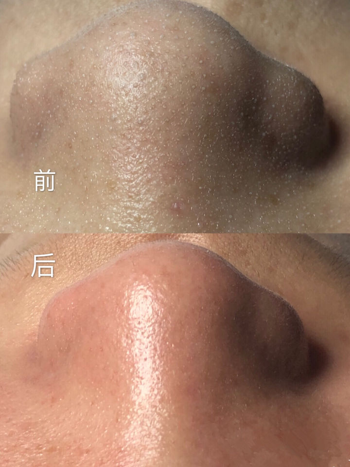 20年的黑头有多大,世界上最长的黑头到底有多长