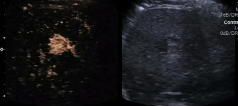 肝内血管瘤和肝癌超声怎么区分,肝占位病理检测项目