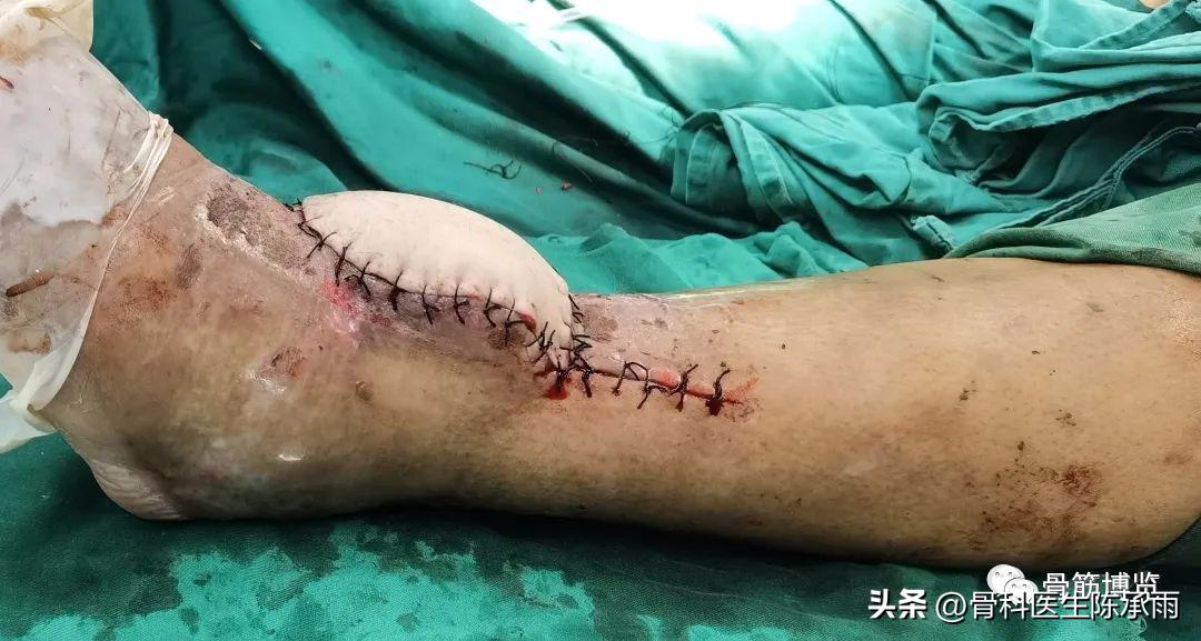 娓哥鐨摚淇,涔旀皬鐨摚淇瓒宠儗澶栦晶鐨偆缂烘崯