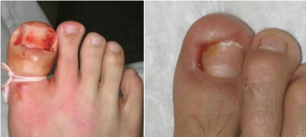 如何预防嵌甲,嵌甲预防方法科普视频