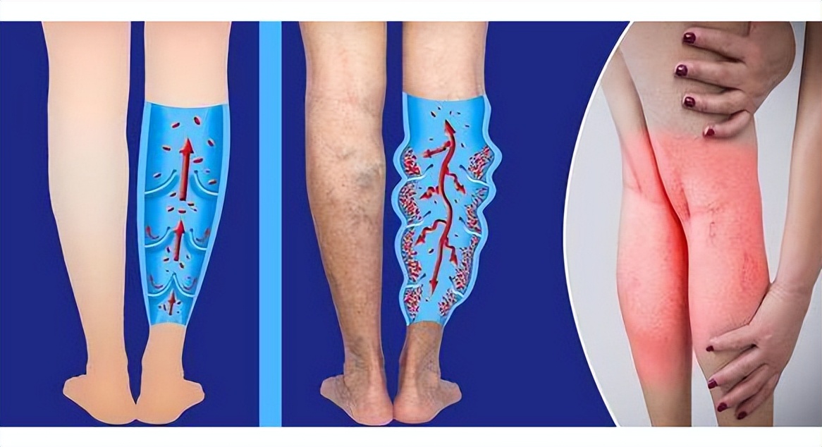 北京医院血管外科刁永鹏抖音,血管外科刁永鹏主任