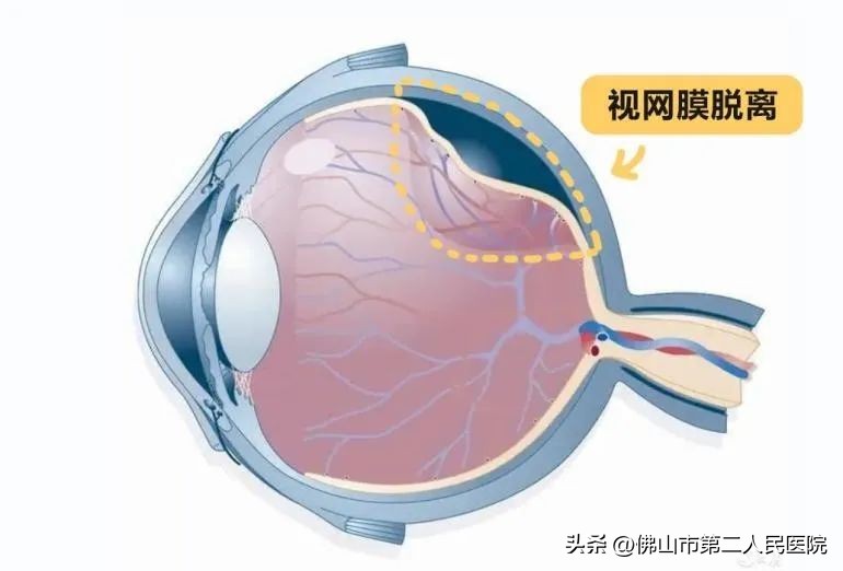 眼睛突然看不见视网膜脱落,视网膜脱离眼睛失明能看好吗