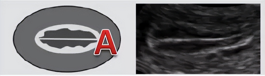 试管婴儿优质胚胎,试管婴儿胚胎着床几率高吗